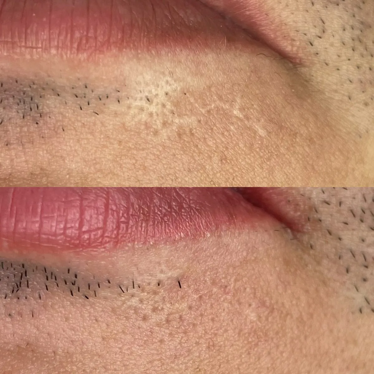 Resultado de Camuflagem de Cicatriz na Carla Soares Beauty, Vila Mariana