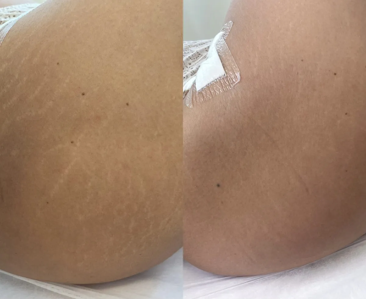 Resultado de Estímulo de Colágeno na Carla Soares Beauty, Vila Mariana